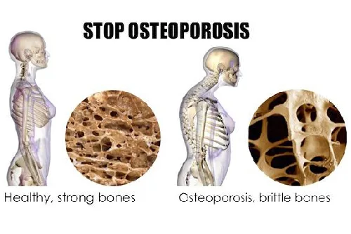 🦴 Osteopenia (tiền loãng xương) – “sát thủ vô hình” bạn không nên bỏ qua